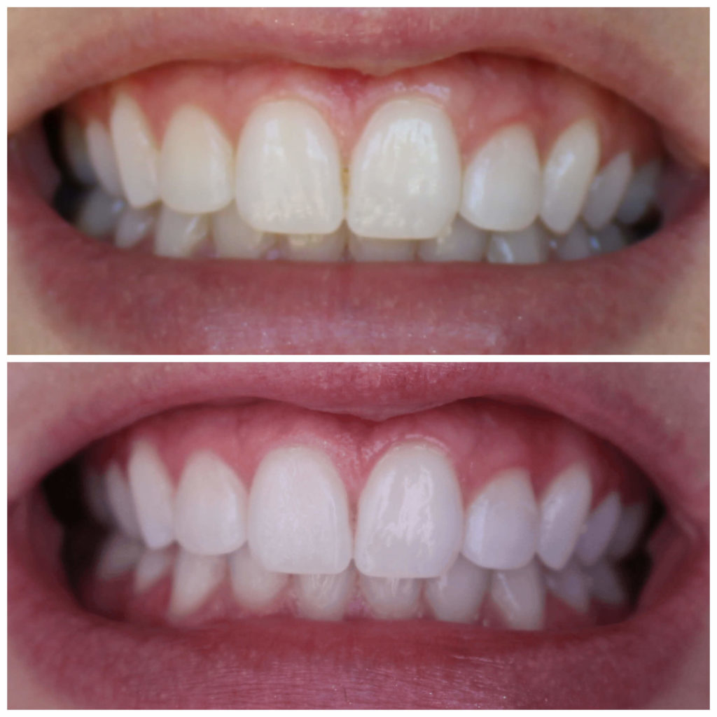 smile brilliant teeth whitening results simply stephaniekay